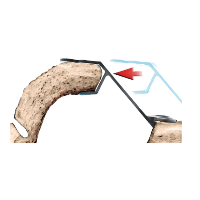 Ceruicis Plate System-Open Porta Plate