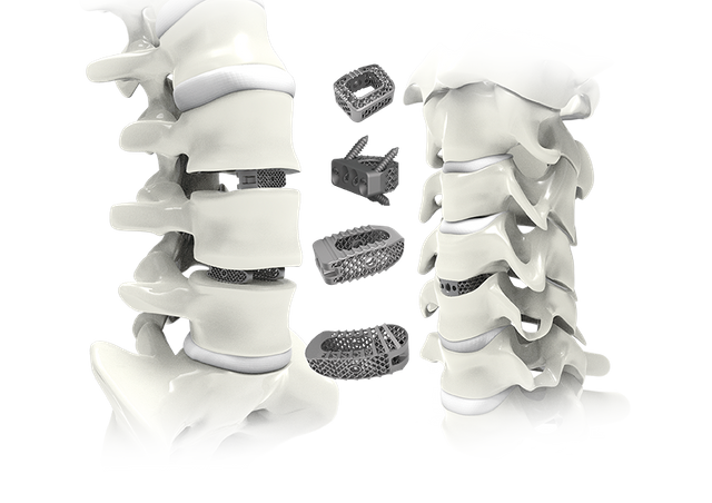 TraUhui Interbody Fusion Cage-3D Cetak Sistem Cage