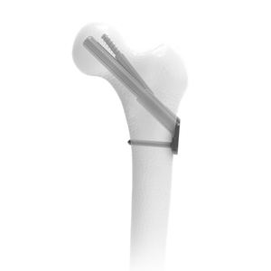 Femoral Neck System