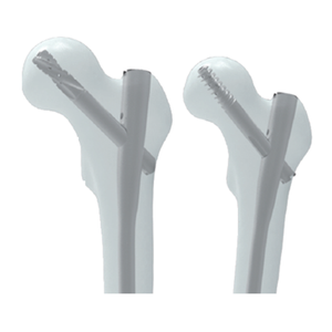 Ramiz Mraedulyar tirnoq tizimi - proksimal femorel mix