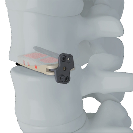 Trauhui Interbody Fusion Cage -Coales XL( XLIF )