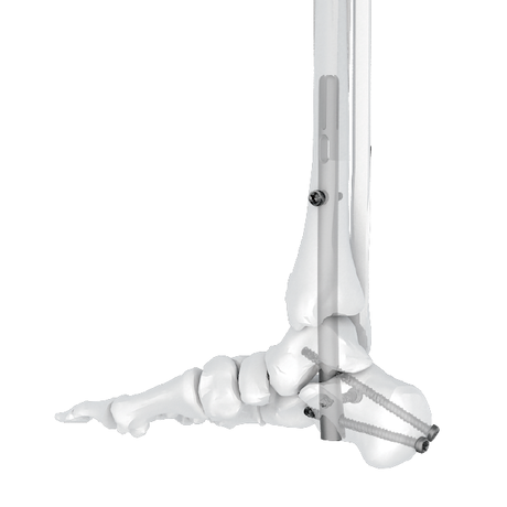 Ramicus clavus intramedullarius systema tarso Arthrodesis clavus