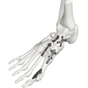 Compant-MD o'zgaruvchan burcha qulflash plitalari tizimi