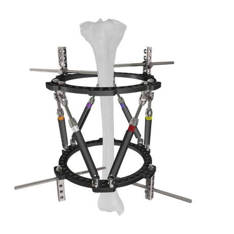 Trauhui Titania-Fix Circularis Externi Fixation Support