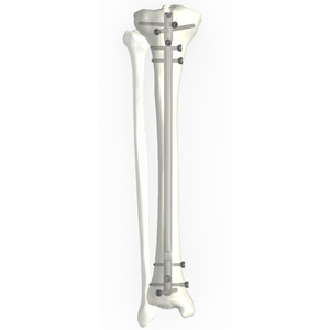 Ramic intramedullary nail system-tibial kuko