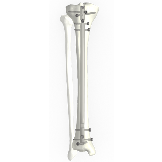 ระบบเล็บ Ramic Intramedullary - Tibial Nail