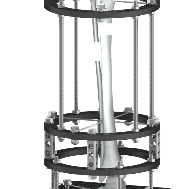 Trauhui Titan-Fix دعم التثبيت الخارجي الدائري