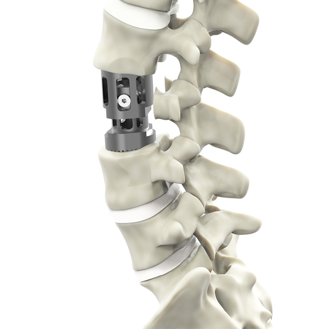 coapt telescopic corpectomy ระบบ corpectomy